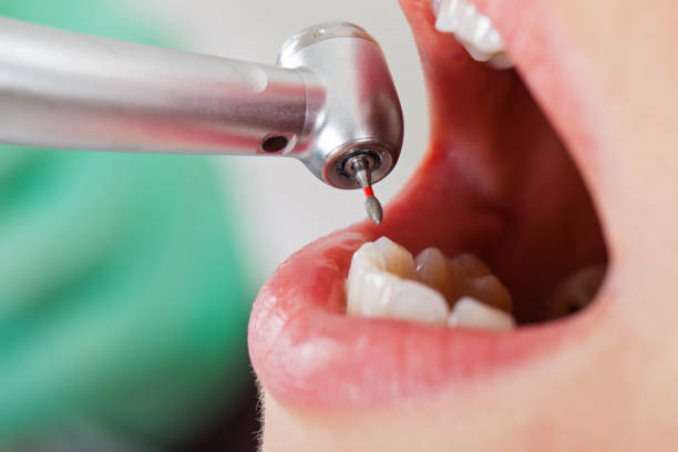 Best Emergency Root Canal Treatment in St James, MD